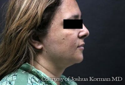 Rhinoplasty Before & After Gallery - Patient 277510 - Image 2