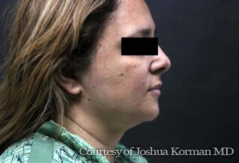 Rhinoplasty Before & After Gallery - Patient 277510 - Image 2