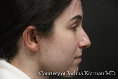 Rhinoplasty Before & After Gallery - Patient 169473 - Image 1