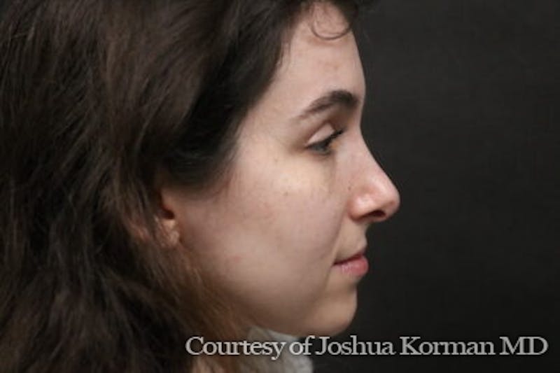 Rhinoplasty Before & After Gallery - Patient 169473 - Image 2