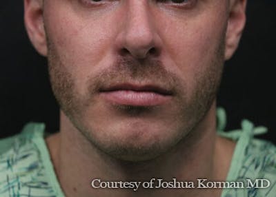 Chin Implants Before & After Gallery - Patient 129579 - Image 1