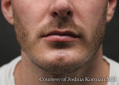 Chin Implants Before & After Gallery - Patient 129579 - Image 2