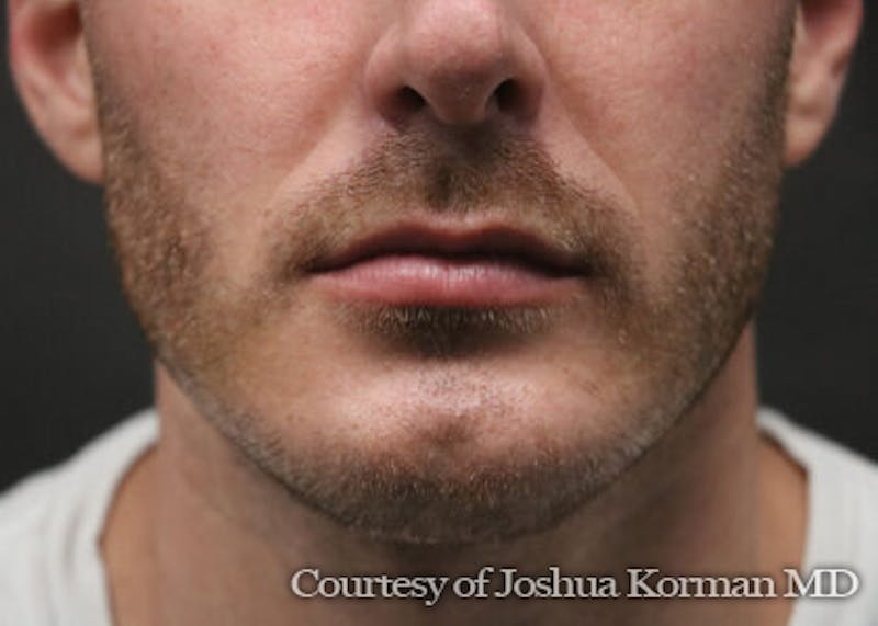 Chin Implants Before & After Gallery - Patient 129579 - Image 2