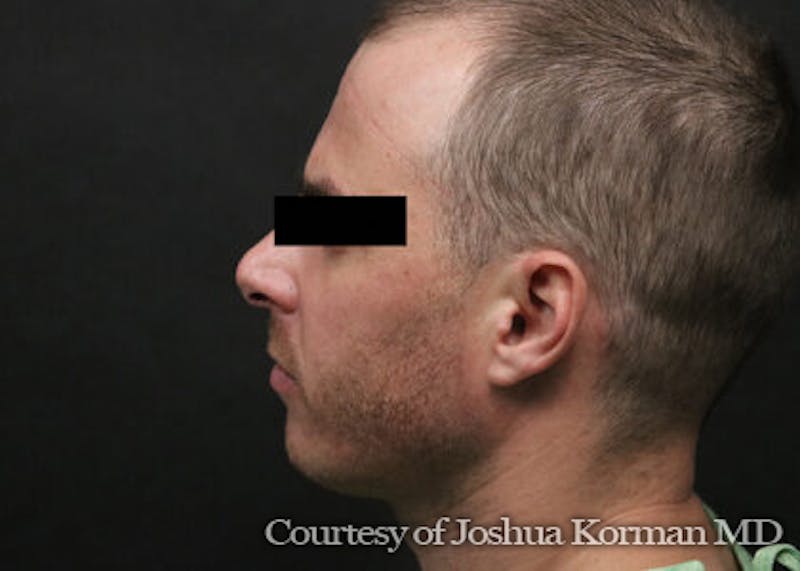 Chin Implants Before & After Gallery - Patient 129579 - Image 3