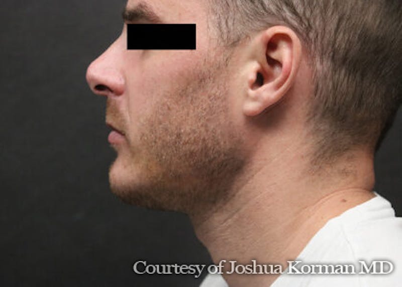 Chin Implants Before & After Gallery - Patient 129579 - Image 4