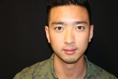 Chin Implants Before & After Gallery - Patient 429454 - Image 1