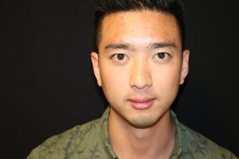 Chin Implants Before & After Gallery - Patient 429454 - Image 1