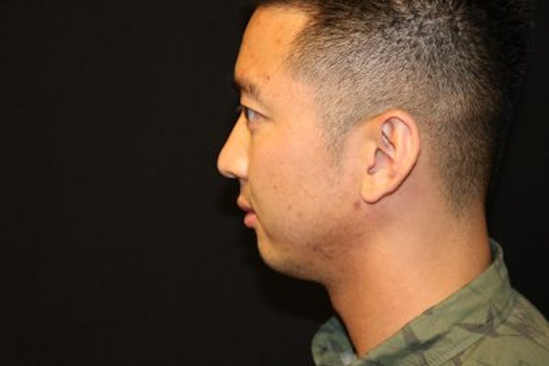 Chin Implants Before & After Gallery - Patient 429454 - Image 3
