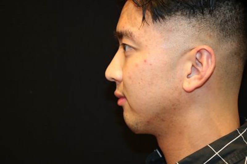 Chin Implants Before & After Gallery - Patient 429454 - Image 4
