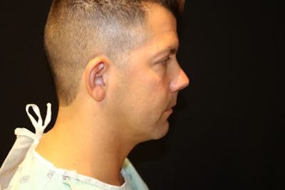 Chin Implants Before & After Gallery - Patient 249876 - Image 1