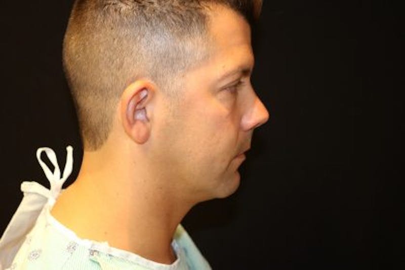 Chin Implants Before & After Gallery - Patient 249876 - Image 1