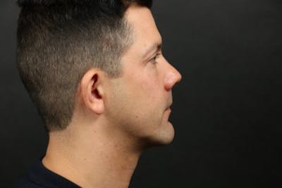 Chin Implants Before & After Gallery - Patient 249876 - Image 2