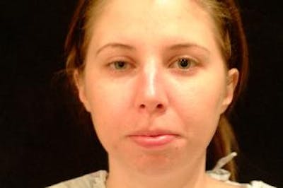 Chin Implants Before & After Gallery - Patient 275989 - Image 1