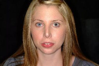 Chin Implants Before & After Gallery - Patient 275989 - Image 2