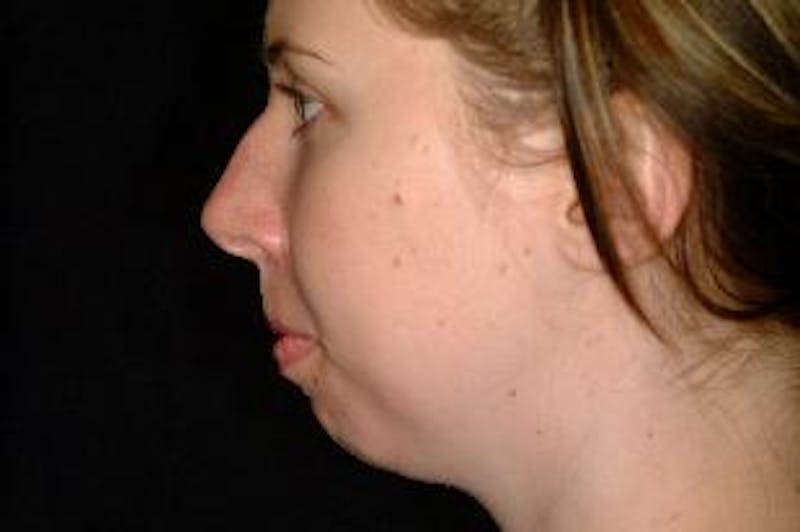 Chin Implants Before & After Gallery - Patient 275989 - Image 3