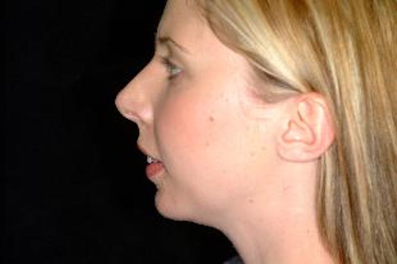 Chin Implants Before & After Gallery - Patient 275989 - Image 4