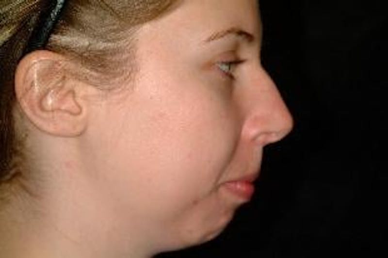 Chin Implants Before & After Gallery - Patient 275989 - Image 5