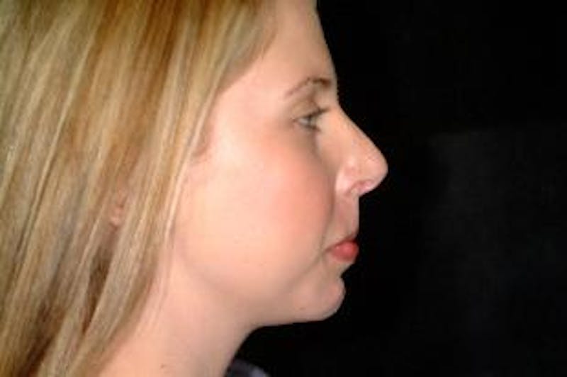 Chin Implants Before & After Gallery - Patient 275989 - Image 6