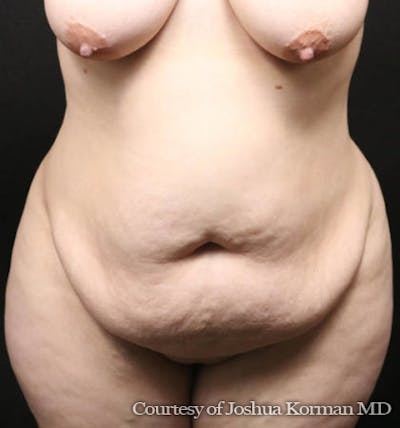 Mommy Makeover Before & After Gallery - Patient 220871 - Image 1