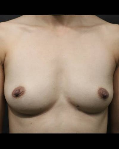 Breast Augmentation Before & After Gallery - Patient 244040 - Image 1