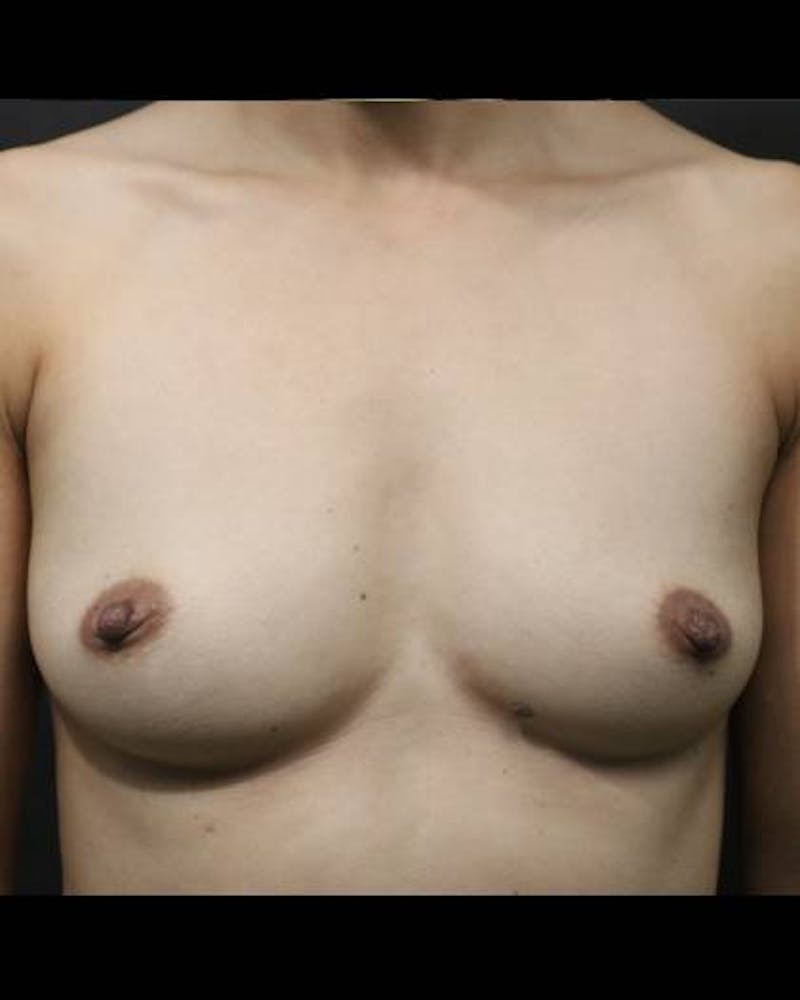 Breast Augmentation Before & After Gallery - Patient 244040 - Image 1