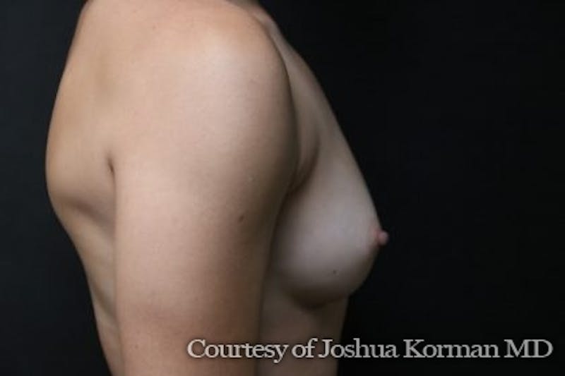 Breast Augmentation Before & After Gallery - Patient 294947 - Image 5