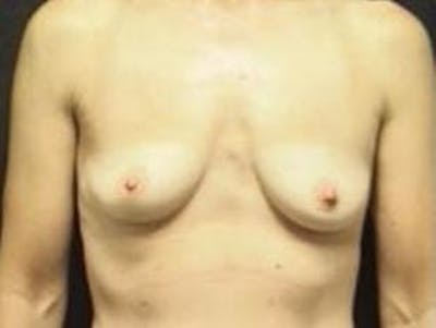 Breast Augmentation Before & After Gallery - Patient 429625 - Image 1