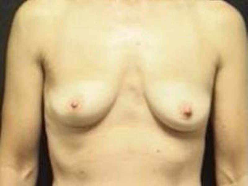 Breast Augmentation Before & After Gallery - Patient 429625 - Image 1
