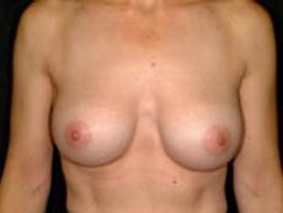 Breast Augmentation Before & After Gallery - Patient 429625 - Image 2