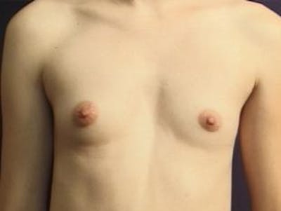 Breast Augmentation Before & After Gallery - Patient 422577 - Image 1