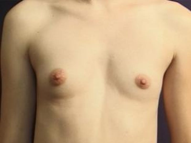 Breast Augmentation Before & After Gallery - Patient 422577 - Image 1