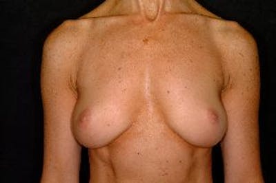 Breast Augmentation Before & After Gallery - Patient 415803 - Image 1
