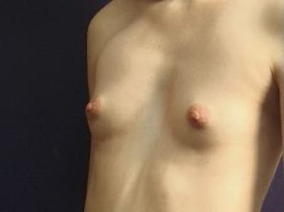 Breast Augmentation Before & After Gallery - Patient 174263 - Image 1