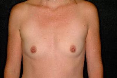 Breast Augmentation Before & After Gallery - Patient 243228 - Image 1