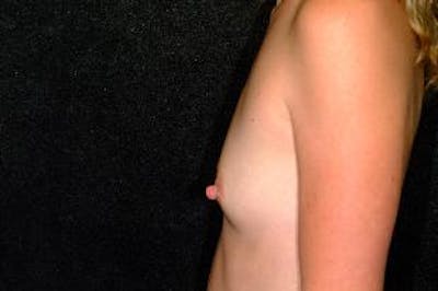 Breast Augmentation Before & After Gallery - Patient 112841 - Image 1
