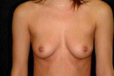 Breast Augmentation Before & After Gallery - Patient 192427 - Image 1