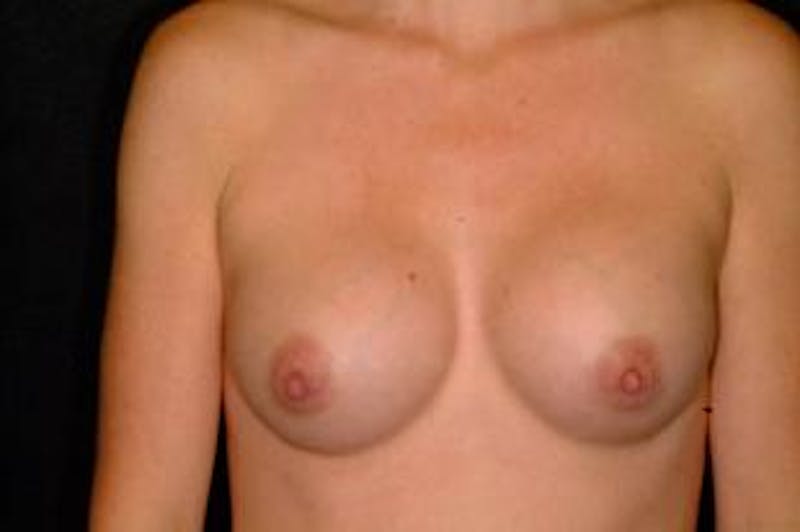 Breast Augmentation Before & After Gallery - Patient 192427 - Image 2