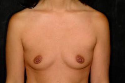 Breast Augmentation Before & After Gallery - Patient 146613 - Image 1