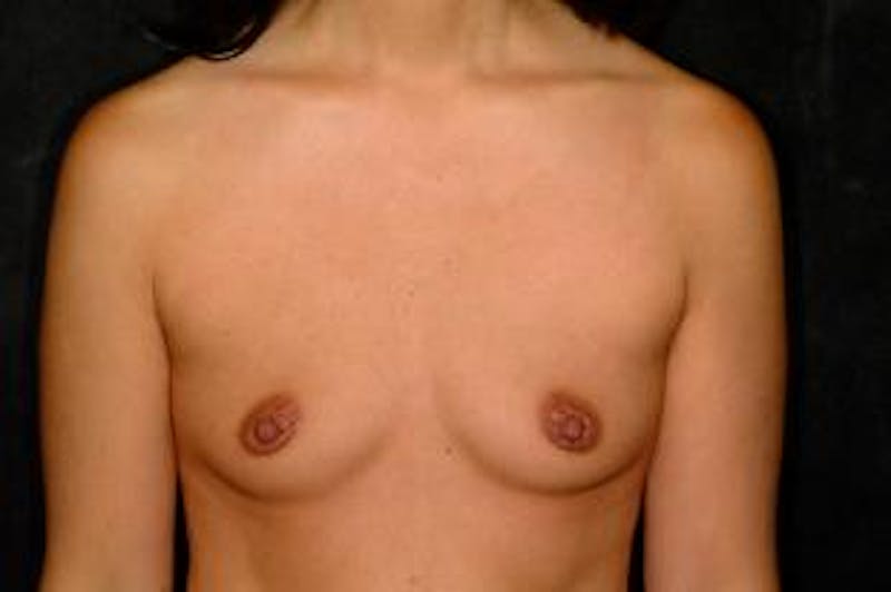 Breast Augmentation Before & After Gallery - Patient 146613 - Image 1