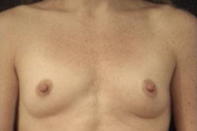 Breast Augmentation Before & After Gallery - Patient 387920 - Image 1