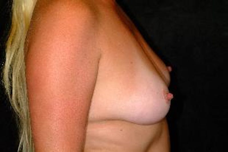 Breast Augmentation Before & After Gallery - Patient 465919 - Image 7