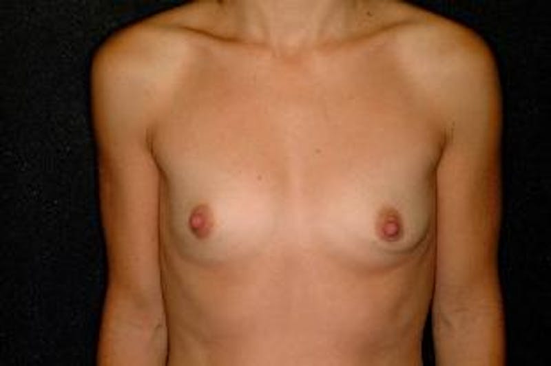 Breast Augmentation Before & After Gallery - Patient 381156 - Image 1