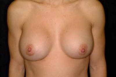 Breast Augmentation Before & After Gallery - Patient 381156 - Image 2