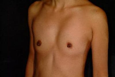 Breast Augmentation Before & After Gallery - Patient 441419 - Image 1