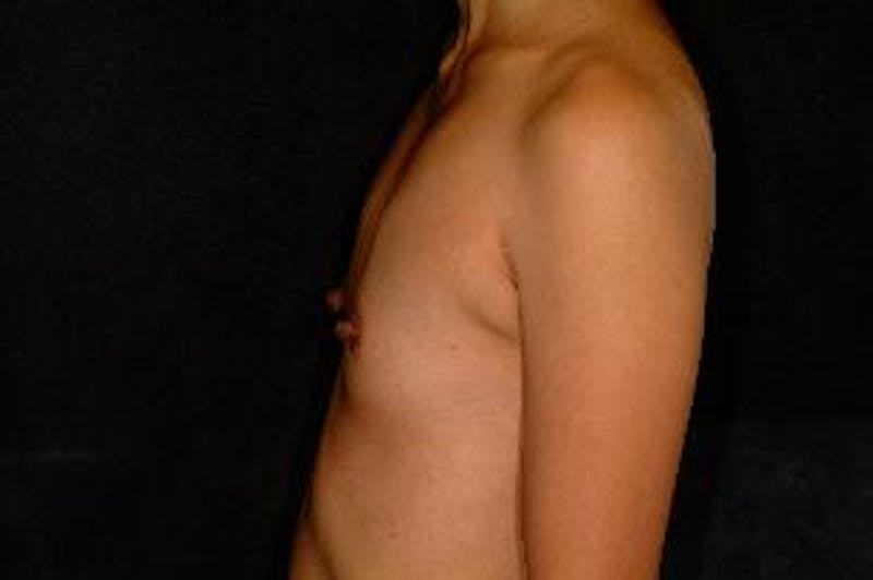 Breast Augmentation Before & After Gallery - Patient 441419 - Image 3