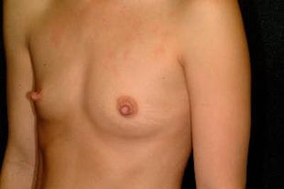 Breast Augmentation Before & After Gallery - Patient 255193 - Image 1