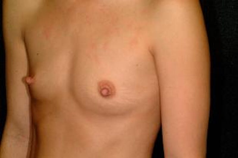 Breast Augmentation Before & After Gallery - Patient 255193 - Image 1