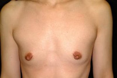 Breast Augmentation Before & After Gallery - Patient 119188 - Image 1