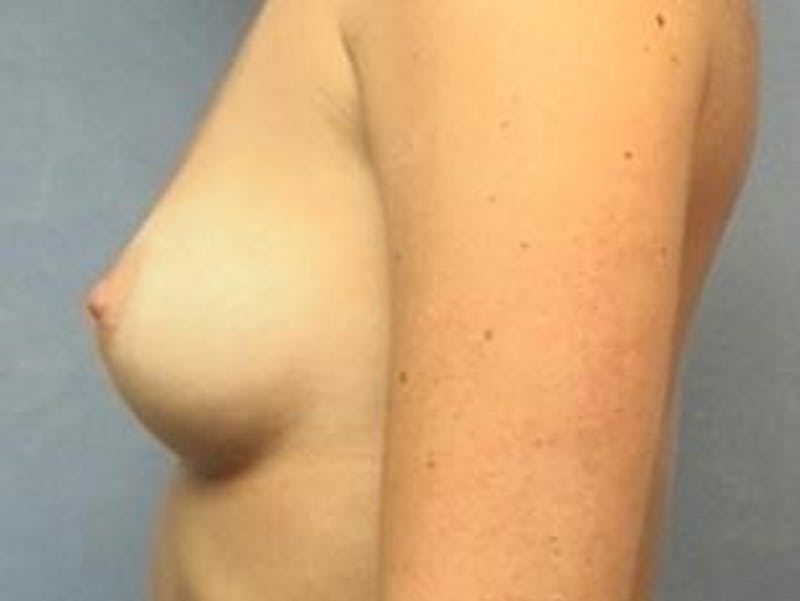 Breast Augmentation Before & After Gallery - Patient 118812 - Image 3