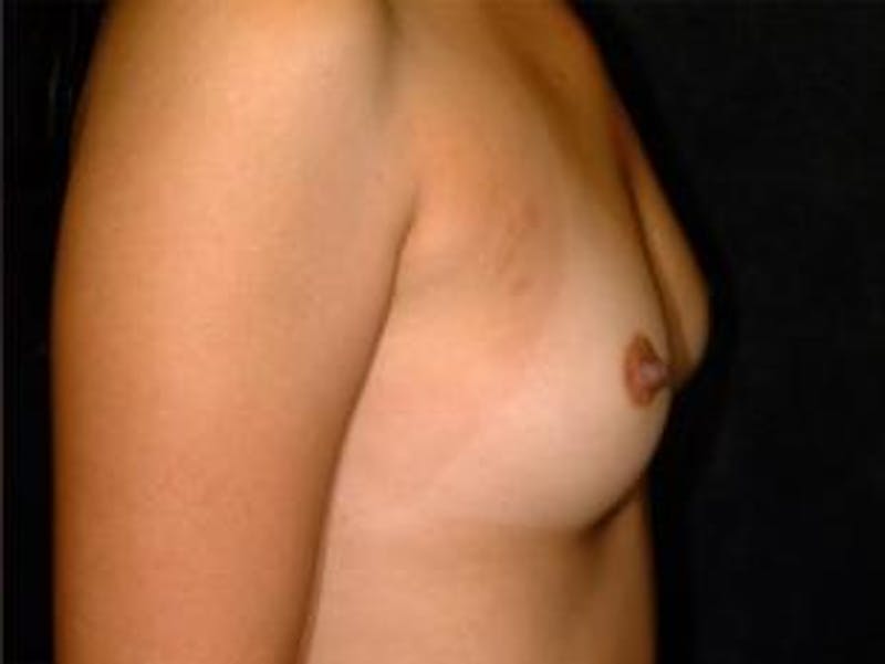 Breast Augmentation Before & After Gallery - Patient 410216 - Image 1